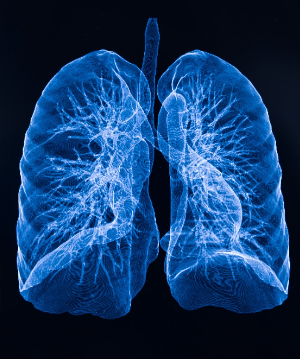 Tracheobronchial airways are identified by numerous airway bifurcations (branches). The MALDA reaches to the 11th airway bifurcation, farther than previous models that only extended to the fourth or fifth. (Photo courtesy of Getty Images)