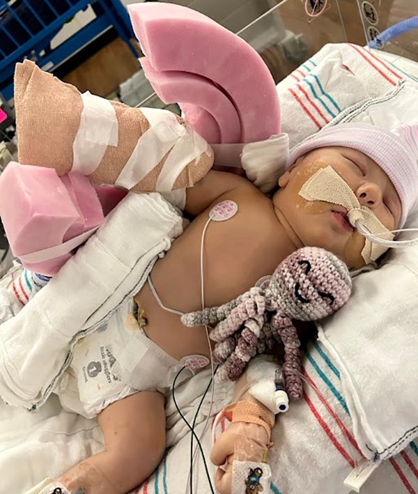 At just 2 weeks old, Isabella Halligan underwent surgery, with a tourniquet placed under her shoulder to lower risk of future arm amputation. (Photo courtesy of Claudia Salas Melchor)
