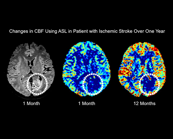 ASL - Image of cerebral blood flow