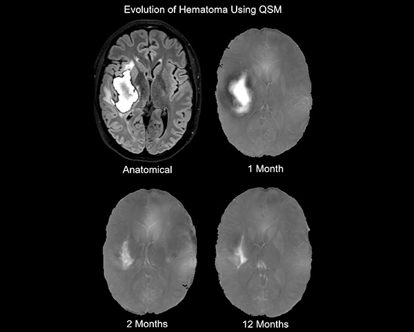 QSM Hematoma Image